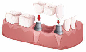 Dental bridge example